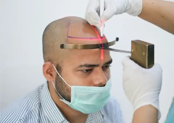 best hair transplant in delhi