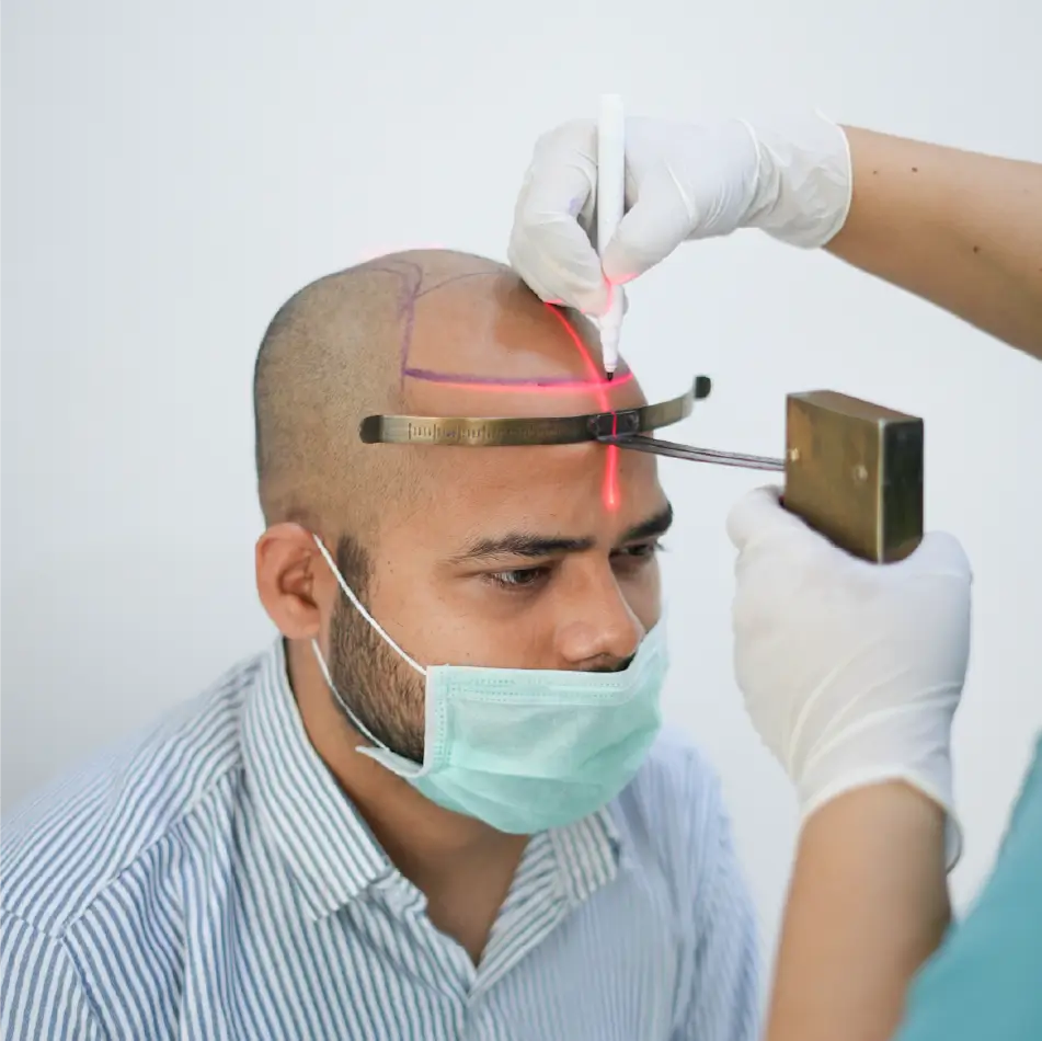 best hair transplant in delhi